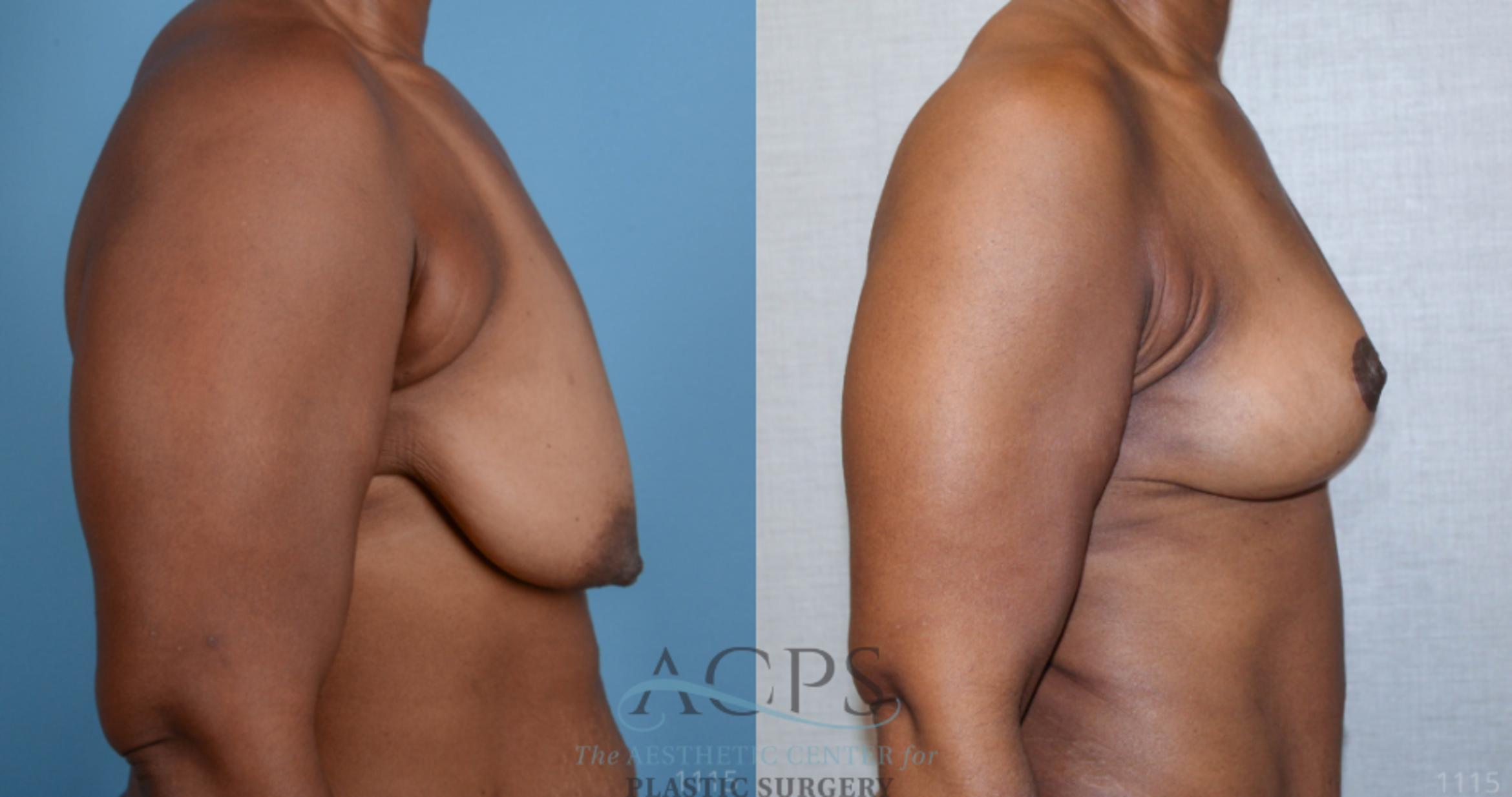 Before & After Breast Lift Case 1101 Side View: View in Houston, TX