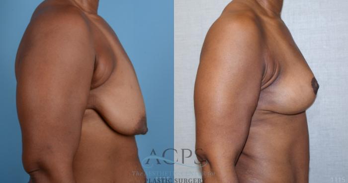 Before & After Breast Lift Case 1101 Side View: View in Houston, TX