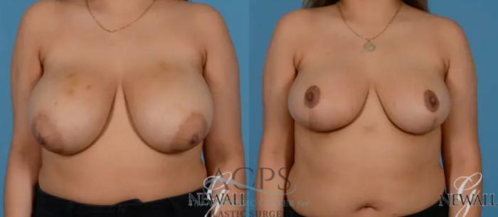 Before & After Breast Lift Case 1102 Front View: View in Houston, TX