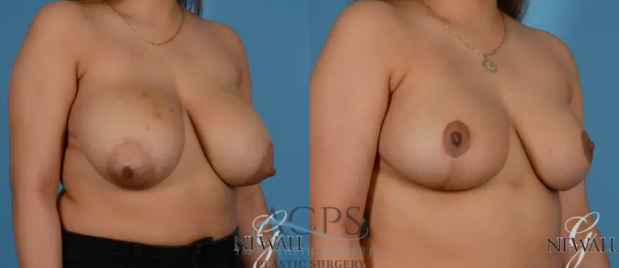 Before & After Breast Lift Case 1102 Oblique View: View in Houston, TX