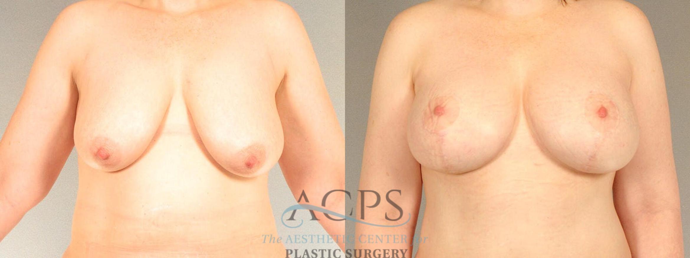 Before & After Breast Lift Case 1103 Front View: View in Houston, TX