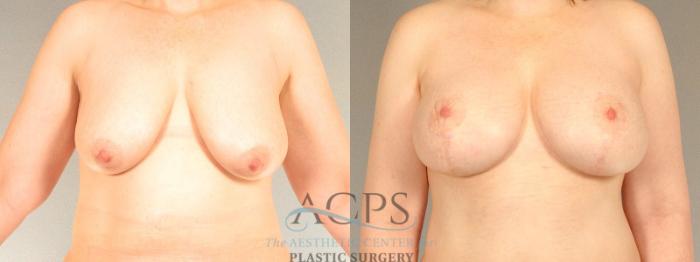 Before & After Breast Lift Case 1103 Front View: View in Houston, TX