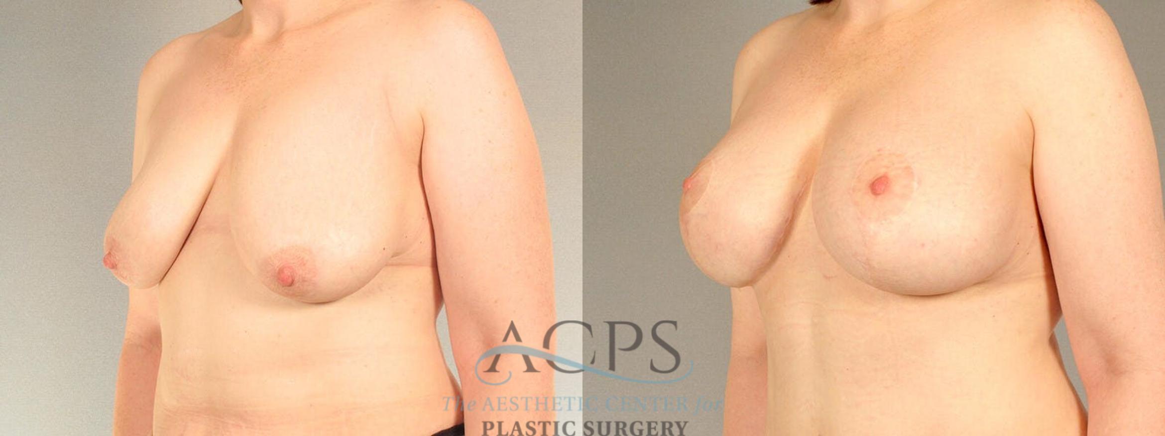 Before & After Breast Lift Case 1103 Oblique View: View in Houston, TX
