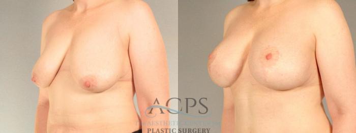 Before & After Breast Lift Case 1103 Oblique View: View in Houston, TX