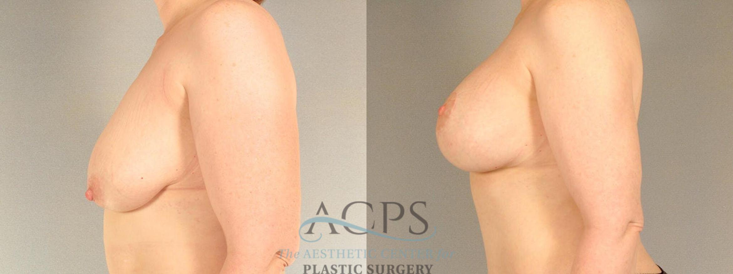 Before & After Breast Lift Case 1103 Side View: View in Houston, TX