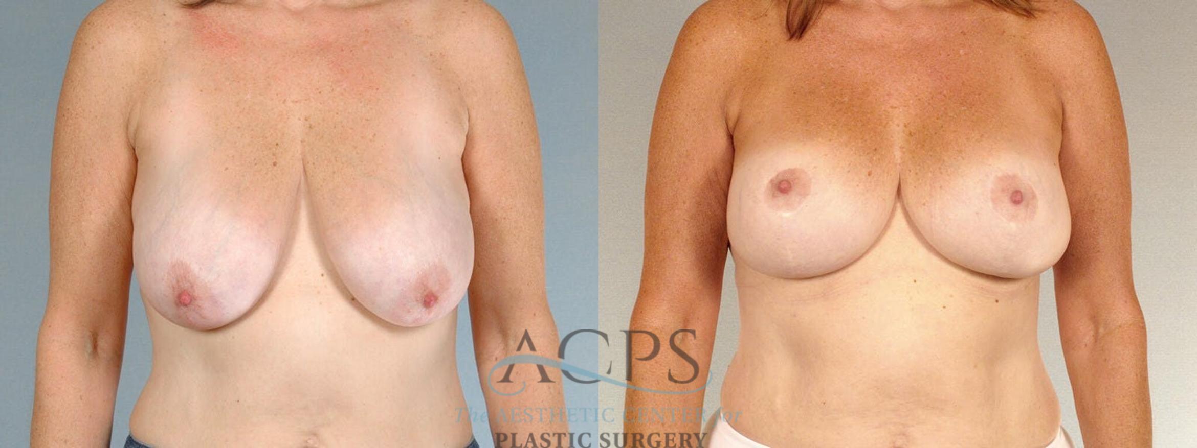 Before & After Breast Lift Case 1104 Front View: View in Houston, TX