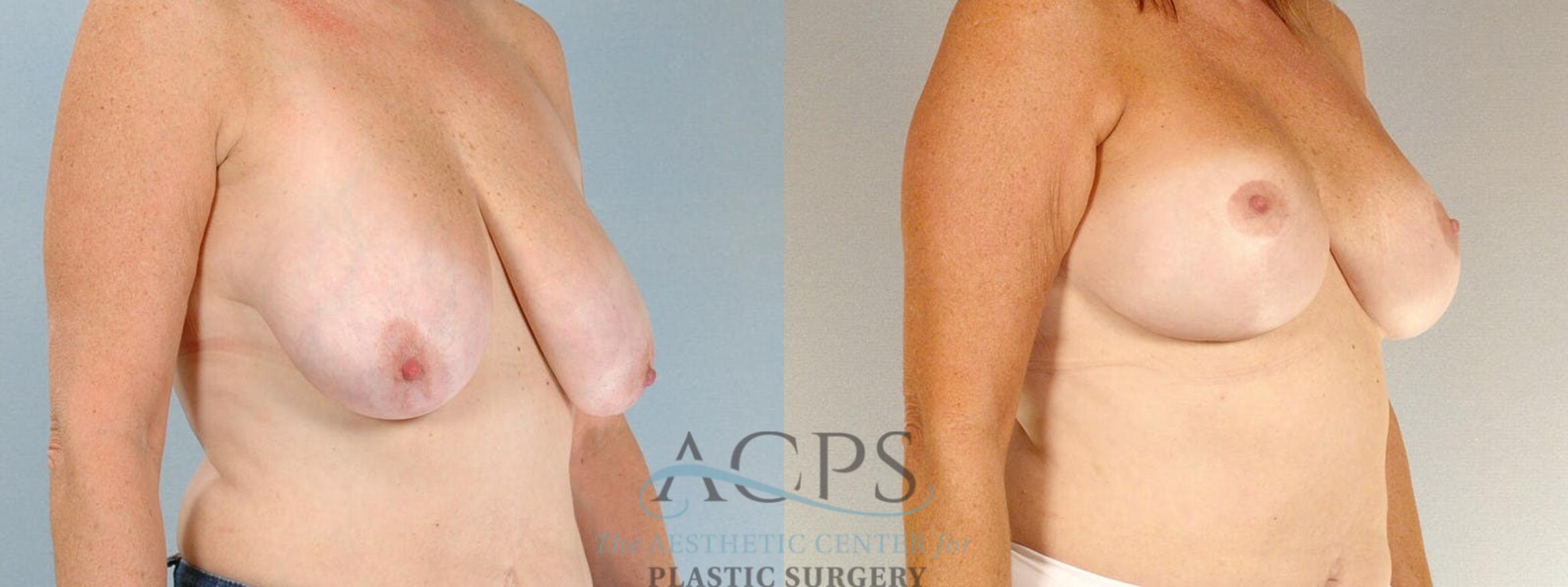 Before & After Breast Lift Case 1104 Oblique View: View in Houston, TX