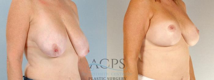 Before & After Breast Lift Case 1104 Oblique View: View in Houston, TX