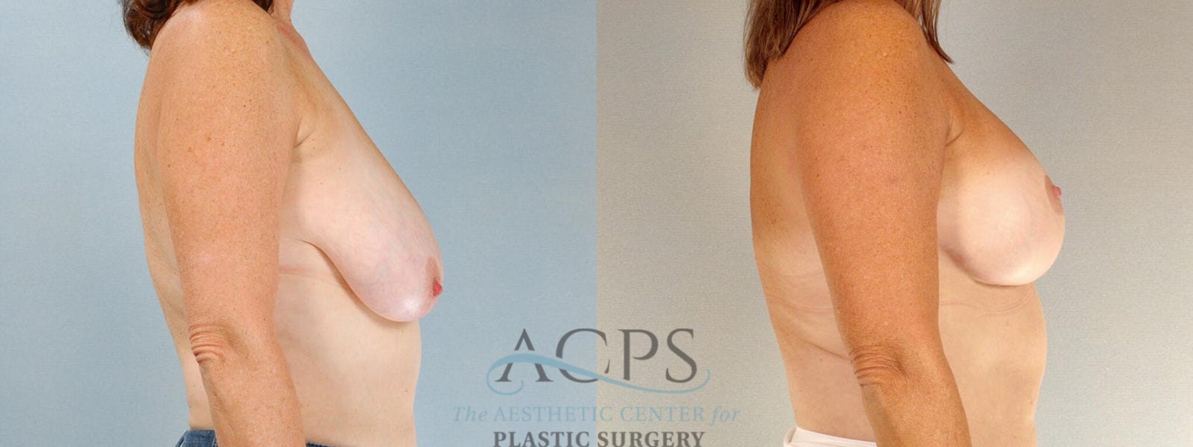 Before & After Breast Lift Case 1104 Side View: View in Houston, TX