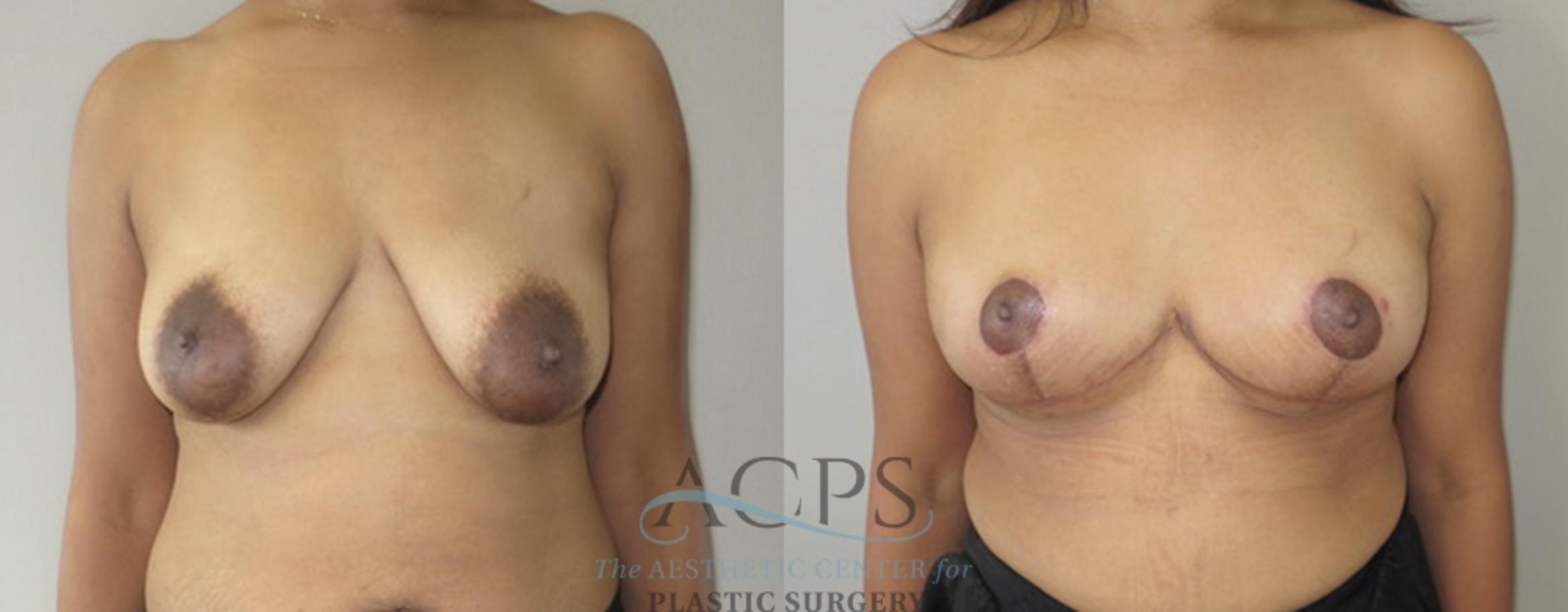 Before & After Breast Lift Case 1105 Front View: View in Houston, TX