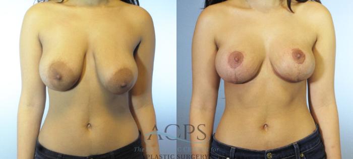 Before & After Breast Lift Case 1107 Front View: View in Houston, TX