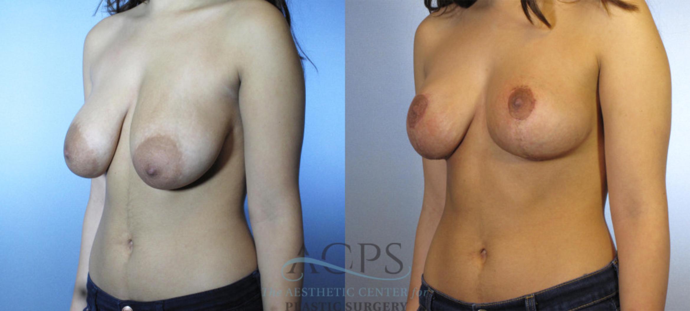 Before & After Breast Lift Case 1107 Oblique View: View in Houston, TX