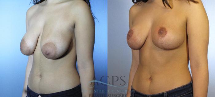Before & After Breast Lift Case 1107 Oblique View: View in Houston, TX