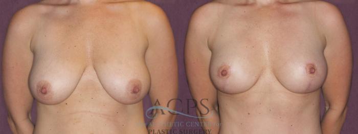 Before & After Breast Lift Case 1108 Front View: View in Houston, TX