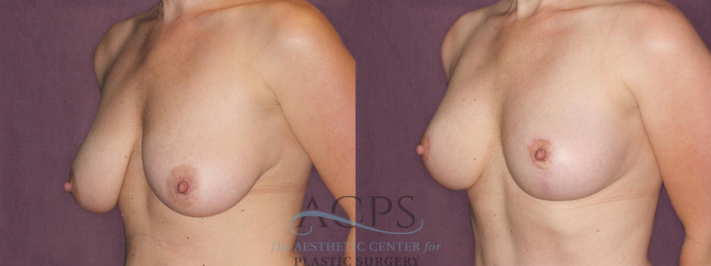 Before & After Breast Lift Case 1108 Oblique Left View: View in Houston, TX
