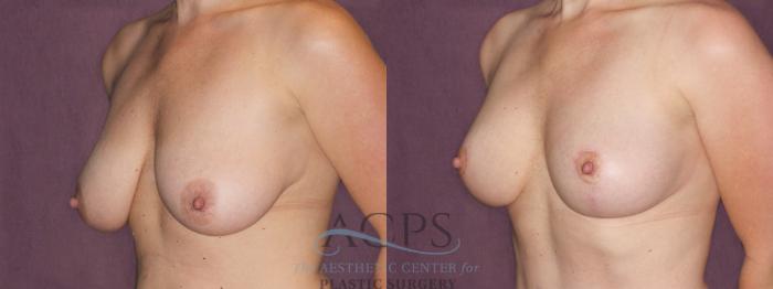 Before & After Breast Lift Case 1108 Oblique Left View: View in Houston, TX