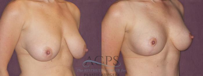 Before & After Breast Lift Case 1108 Oblique Right View: View in Houston, TX
