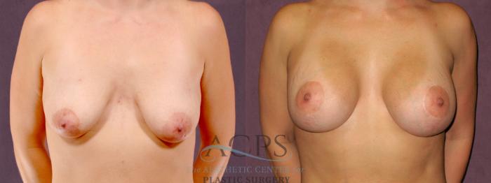 Before & After Breast Lift Case 1109 Front View: View in Houston, TX