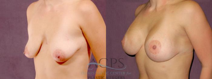 Before & After Breast Lift Case 1109 Oblique Left View: View in Houston, TX