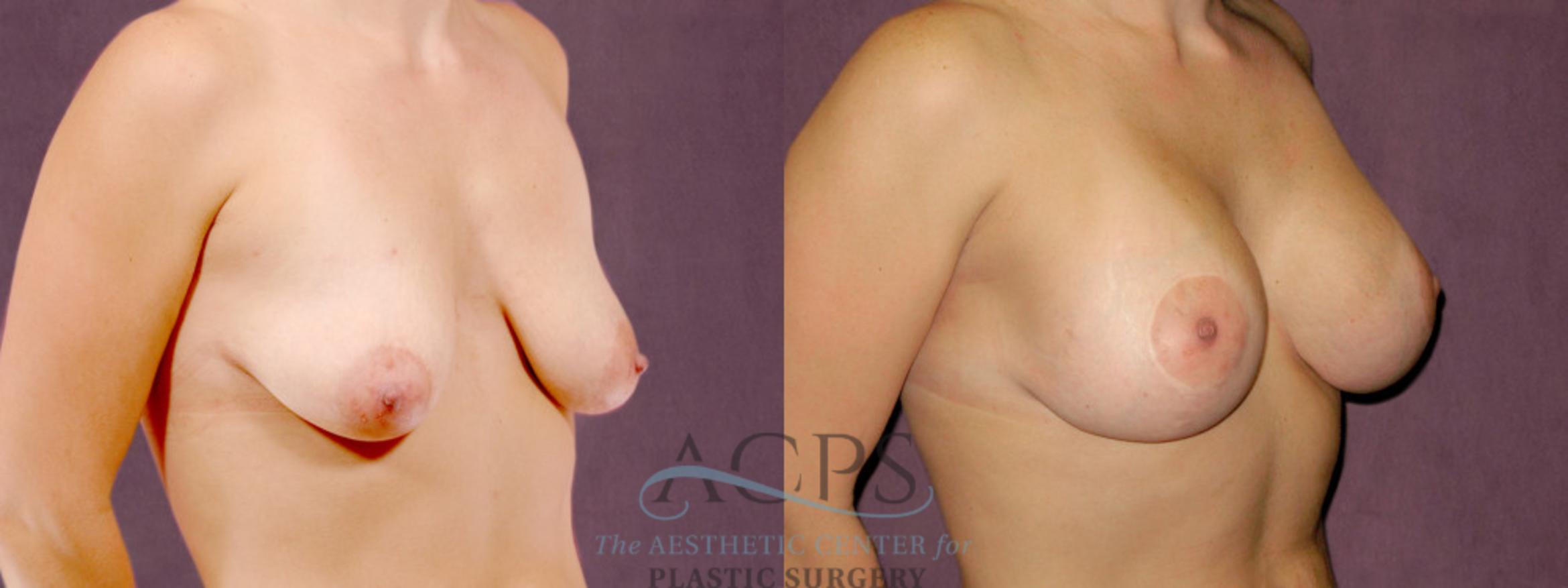 Before & After Breast Lift Case 1109 Oblique Right View: View in Houston, TX
