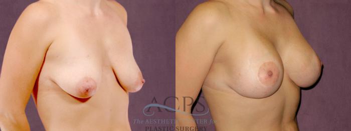 Before & After Breast Lift Case 1109 Oblique Right View: View in Houston, TX