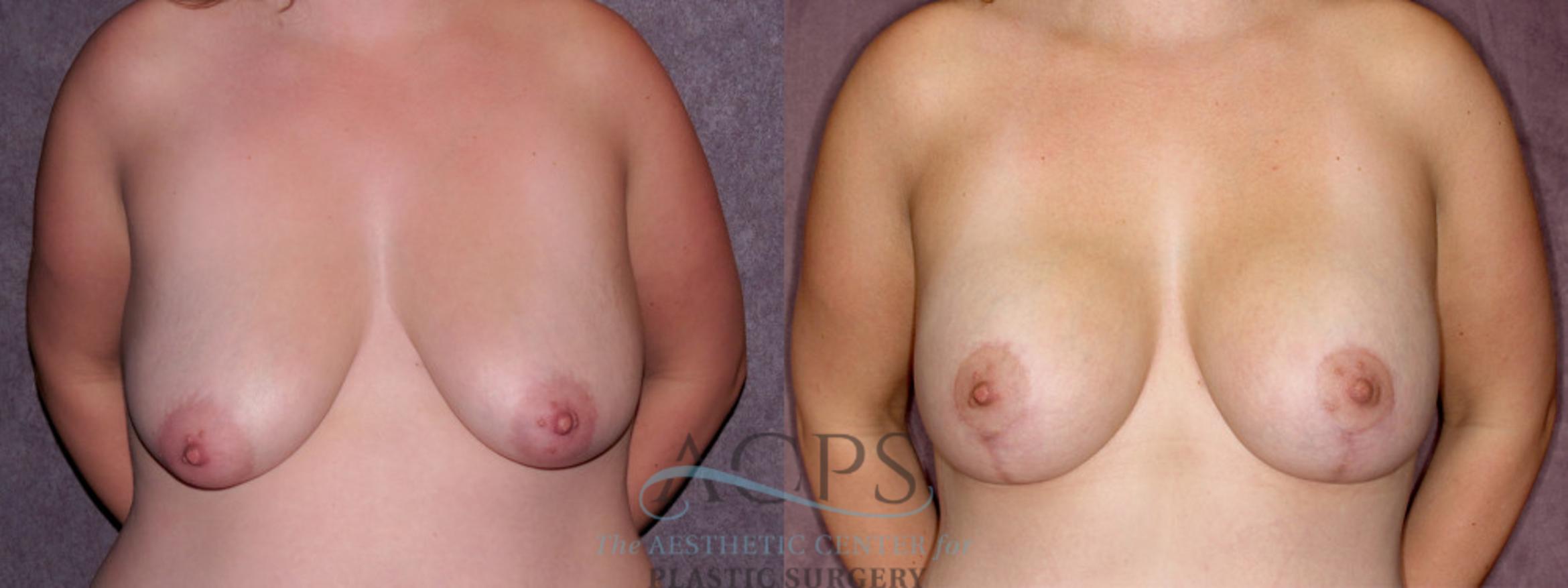 Before & After Breast Lift Case 1110 Front View: View in Houston, TX