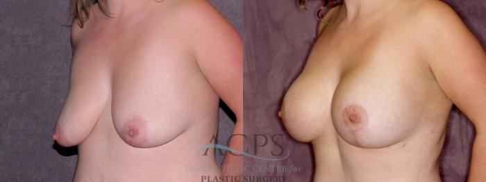 Before & After Breast Lift Case 1110 Oblique Left View: View in Houston, TX