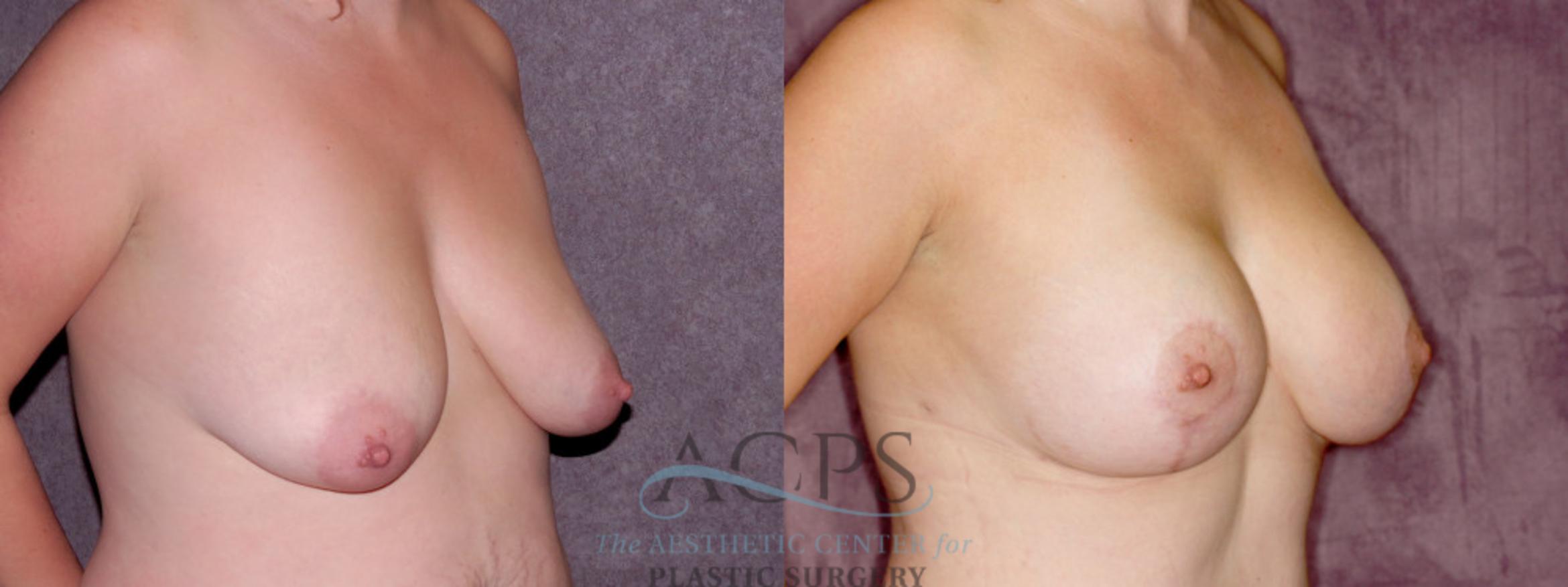 Before & After Breast Lift Case 1110 Oblique Right View: View in Houston, TX