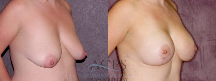 Before & After Breast Lift Case 1110 Oblique Right View: View in Houston, TX