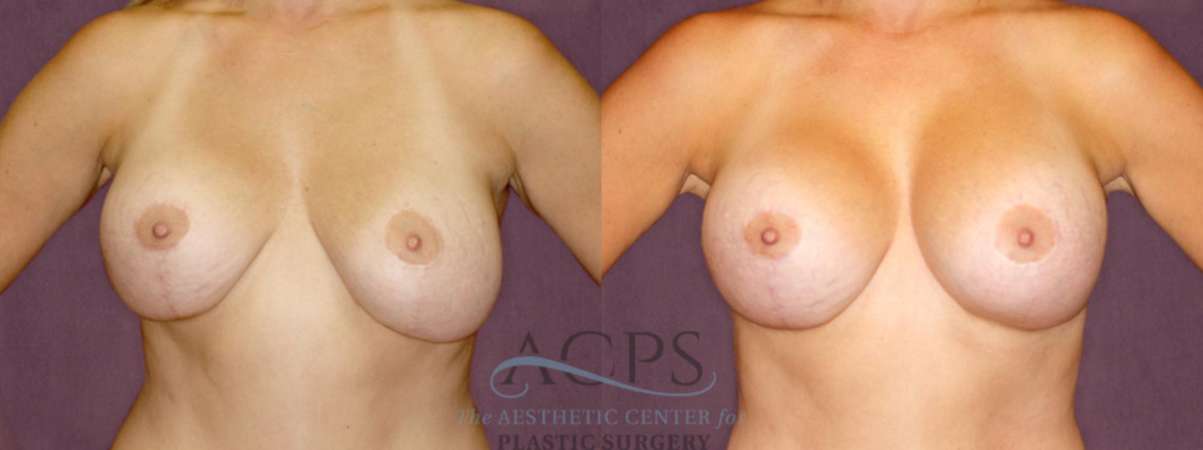 Before & After Breast Lift Case 1111 Front View: View in Houston, TX