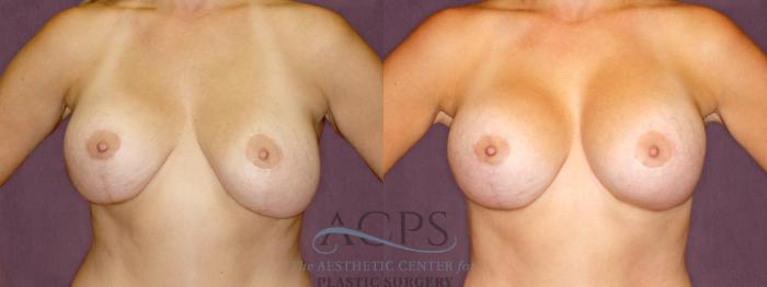 Before & After Breast Lift Case 1111 Front View: View in Houston, TX