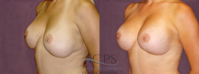 Before & After Breast Lift Case 1111 Oblique Left View: View in Houston, TX