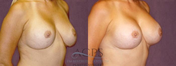 Before & After Breast Lift Case 1111 Oblique Right View: View in Houston, TX