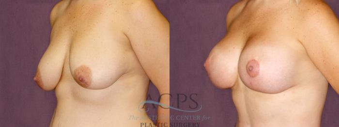 Before & After Breast Lift Case 1112 Oblique Left View: View in Houston, TX