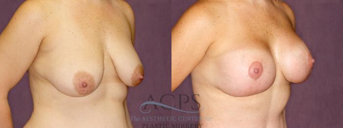 Before & After Breast Lift Case 1112 Oblique Right View: View in Houston, TX
