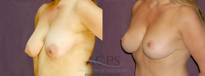 Before & After Breast Lift Case 1113 Oblique Left View: View in Houston, TX