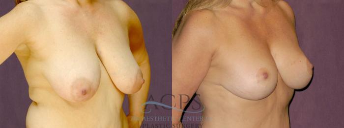 Before & After Breast Lift Case 1113 Oblique Right View: View in Houston, TX