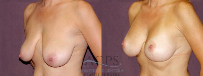 Before & After Breast Lift Case 1114 Oblique Left View: View in Houston, TX