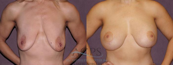 Before & After Breast Lift Case 1115 Front View: View in Houston, TX