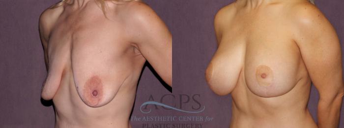 Before & After Breast Lift Case 1115 Oblique Left View: View in Houston, TX