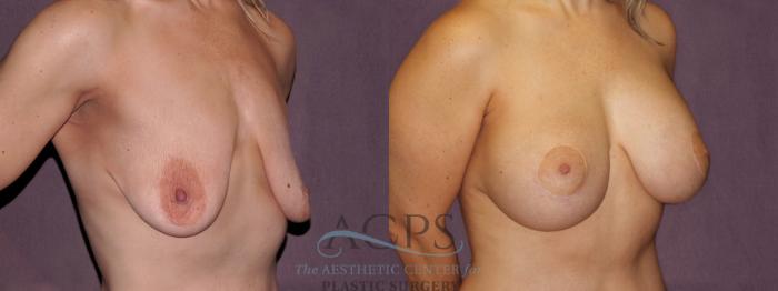 Before & After Breast Lift Case 1115 Oblique Right View: View in Houston, TX