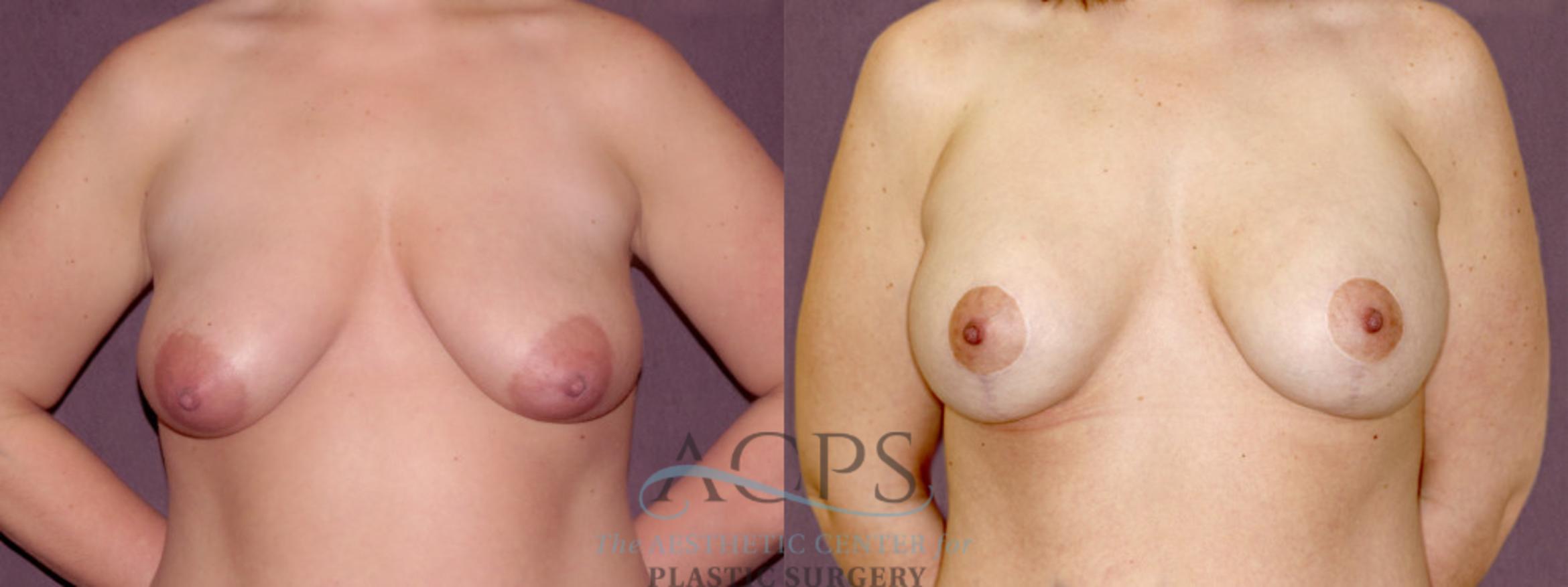 Before & After Breast Lift Case 1116 Front View: View in Houston, TX