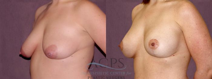 Before & After Breast Lift Case 1116 Oblique Left View: View in Houston, TX