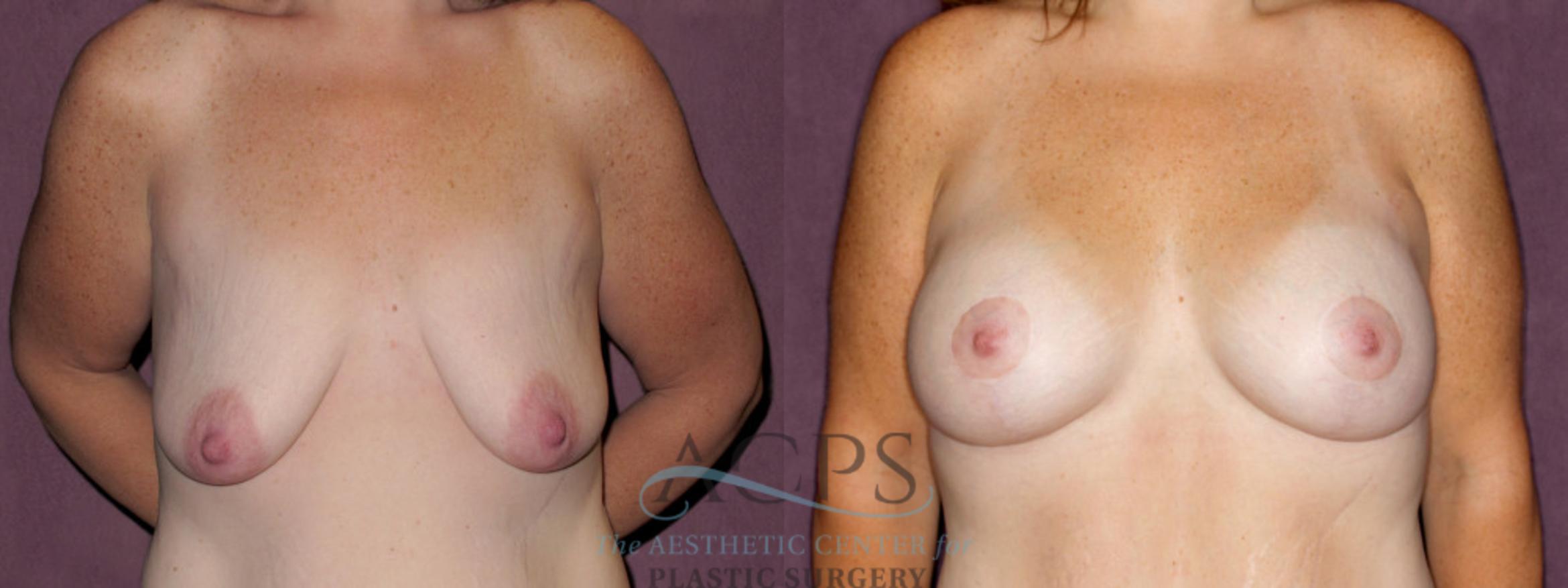 Before & After Breast Lift Case 1117 Front View: View in Houston, TX