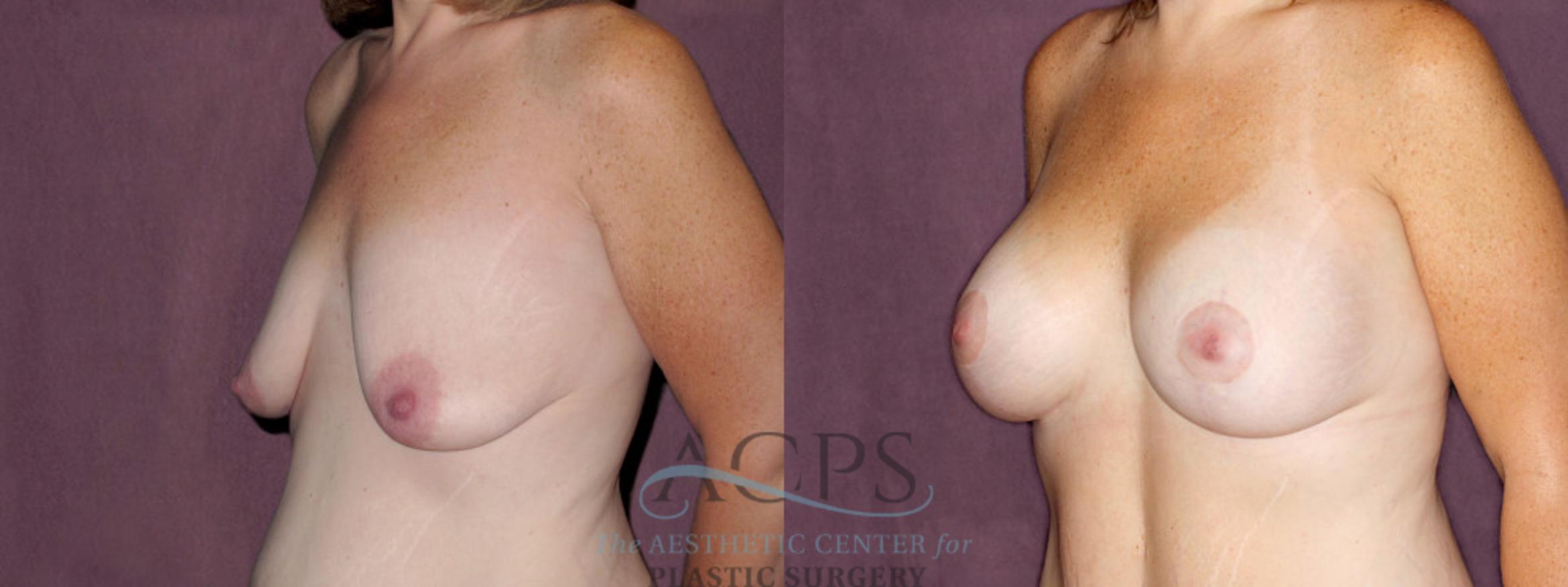 Before & After Breast Lift Case 1117 Oblique Left View: View in Houston, TX