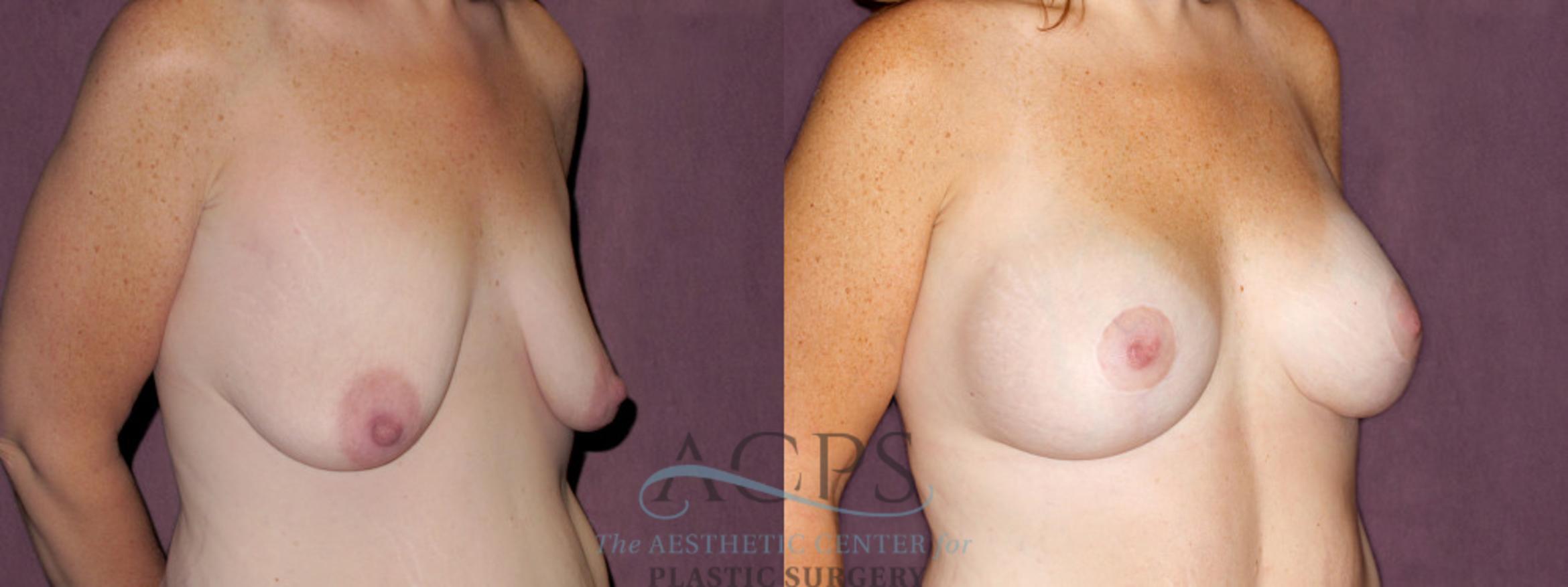 Before & After Breast Lift Case 1117 Oblique Right View: View in Houston, TX