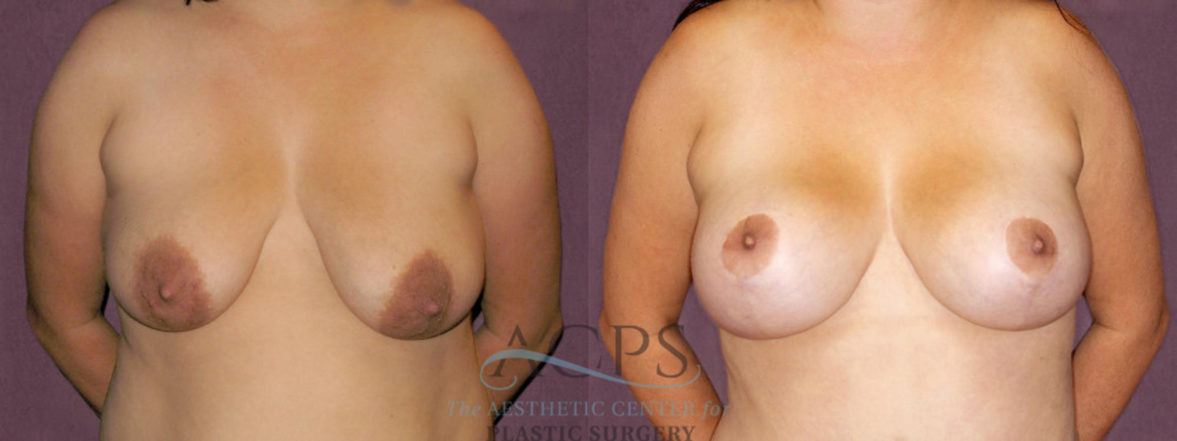 Before & After Breast Lift Case 1118 Front View: View in Houston, TX