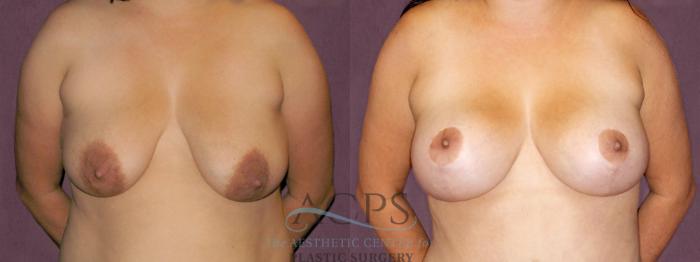 Before & After Breast Lift Case 1118 Front View: View in Houston, TX
