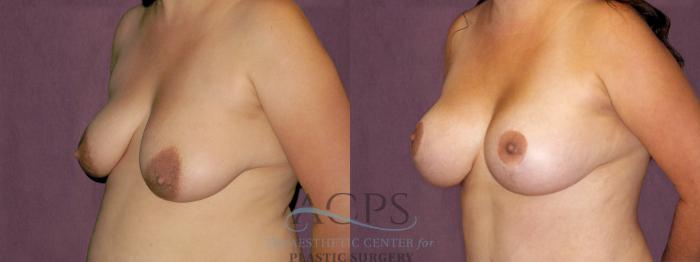 Before & After Breast Lift Case 1118 Oblique Left View: View in Houston, TX