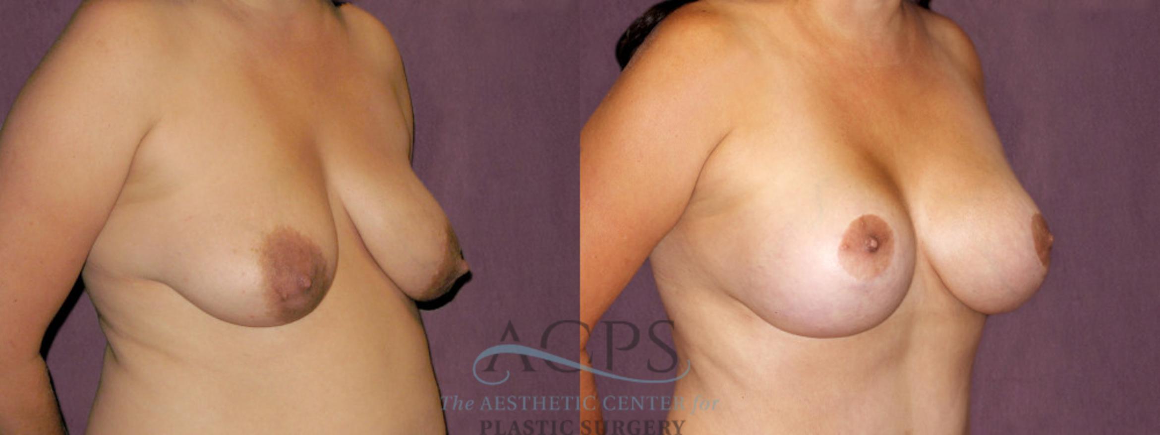 Before & After Breast Lift Case 1118 Oblique Right View: View in Houston, TX
